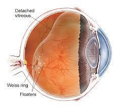 floaters diagram