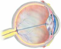 Medical diagram of Open Angle Glaucoma