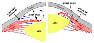 Open Closed Angle Glaucoma Drawing