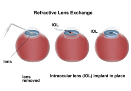 Refractive Lens Exchange diagram