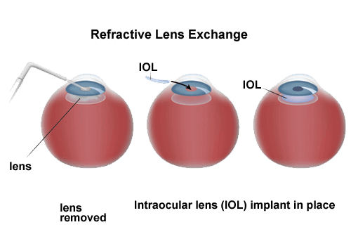 Refractive Lens Exchange diagram