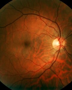 Retina