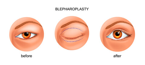 Blepharoplasty diagram