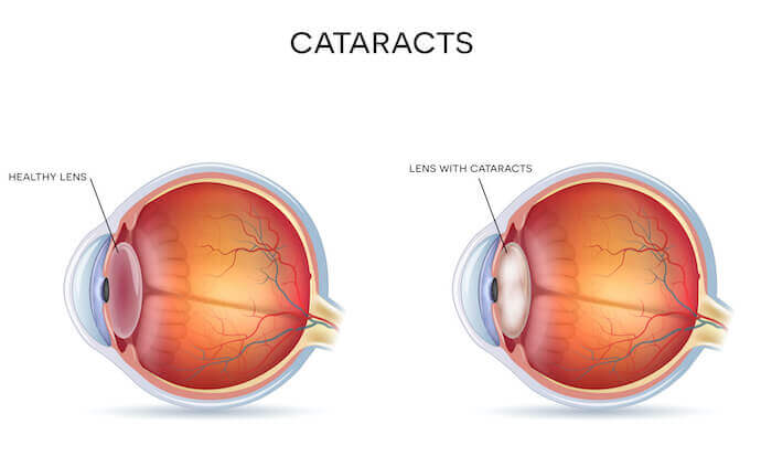 Diagram of cataracts