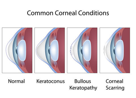 Corneal Conditions Diagram