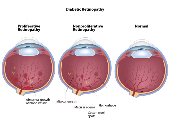 Diabetic Eye Diagram