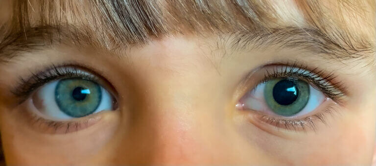 Close up of child's eyes with one of them dilated