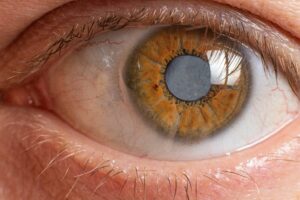 ash in eye from cigarette Knowledge about smoking and your eye health