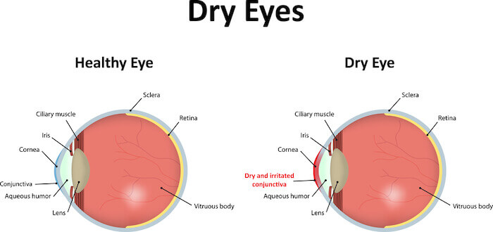 Dry eyes diagram