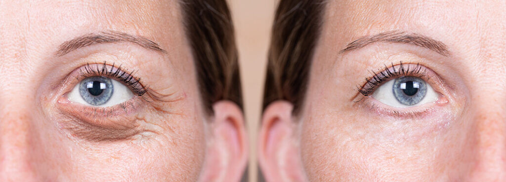 Before and after eyelid surgery