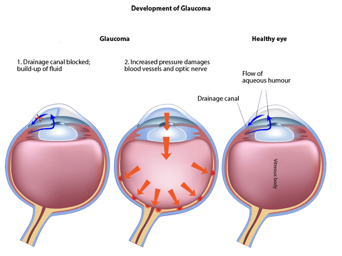 Development of Glaucoma illustration