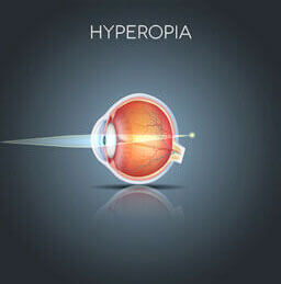 Hyperopia diagram