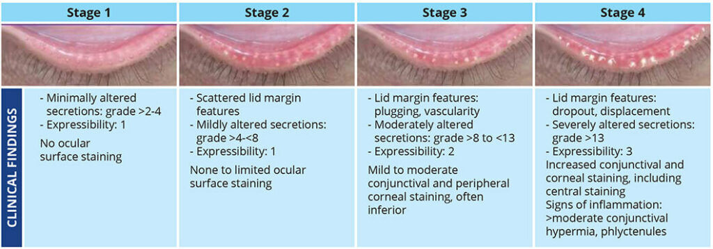 I-Lux procedure chart