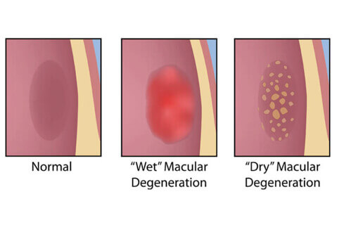 Types of Macular Degeneration