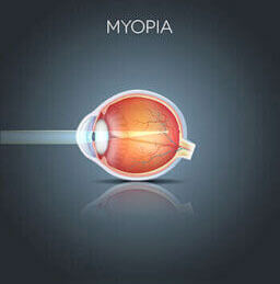 Myopia diagram