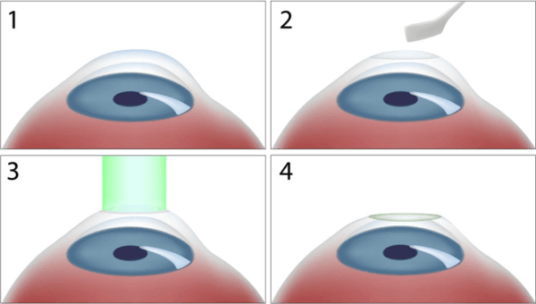 PRK Procedure diagram