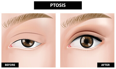 Ptosis Diagram