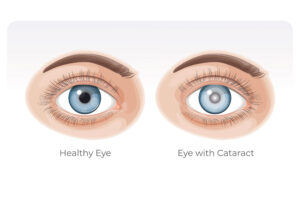 Cataract Surgery in Coupeville Whidbey