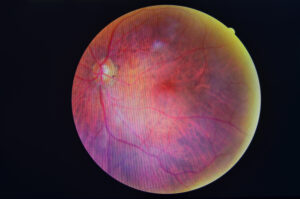 Diabetic Retinopathy in Sedro Woolley