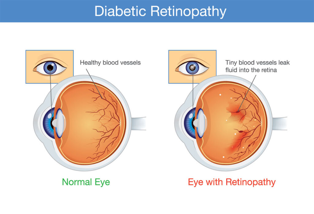 Diabetic Retinopathy treatment in Stanwood WA